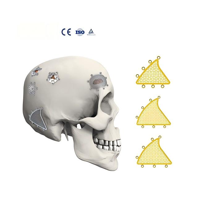 Skull Mastoid Interlink Titanium Plate Anodized Cranial Titanium Mesh for Orthopedic Surgery Cranial Interlink Plates